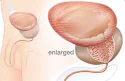 Role of Urologist?