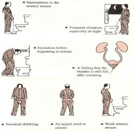 Role of Urologist?