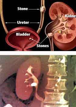 Role of Urologist?