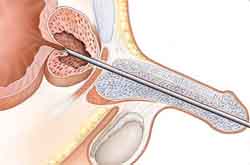 Role of Urologist?